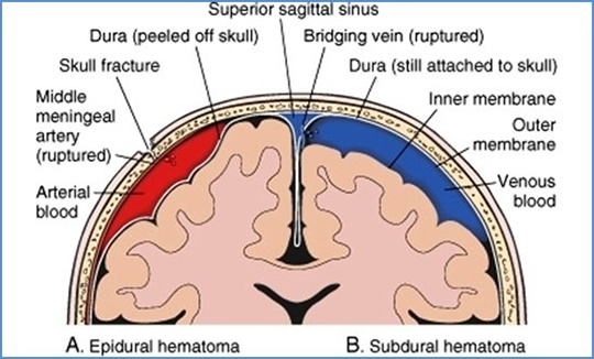 Hematoma subdural hematoma vs epidural Epidural vs