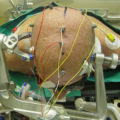 Intraoperative neurophysiological monitoring