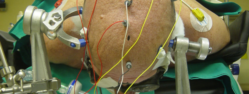 Intraoperative neurophysiological monitoring