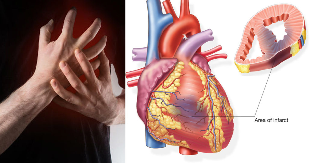 Myocardial Infarction (Heart Attack) | Top Neuro Docs