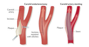 Complications of Carotid Endarterectomy