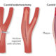 Complications of Carotid Endarterectomy