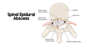 spinal epidural abscess