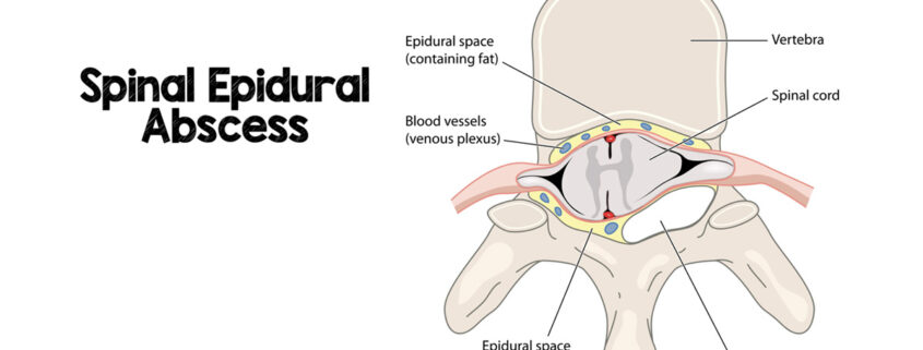 spinal epidural abscess