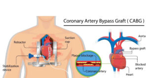 Stroke After Coronary Artery Bypass Grafting and Percutaneous Coronary Intervention
