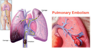 Managing high-risk pulmonary embolism